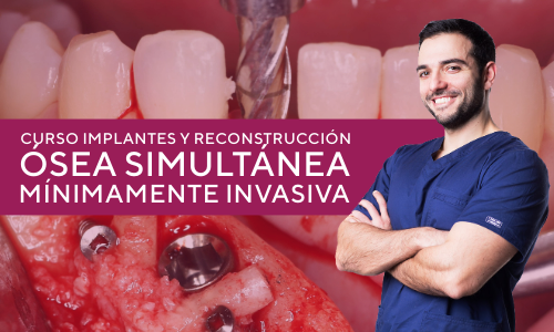 Implantes y reconstrucción ósea simultánea mínimamente invasiva