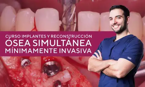 Implantes y reconstrucción ósea simultánea mínimamente invasiva