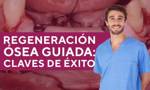 Regeneración-ósea-guiada