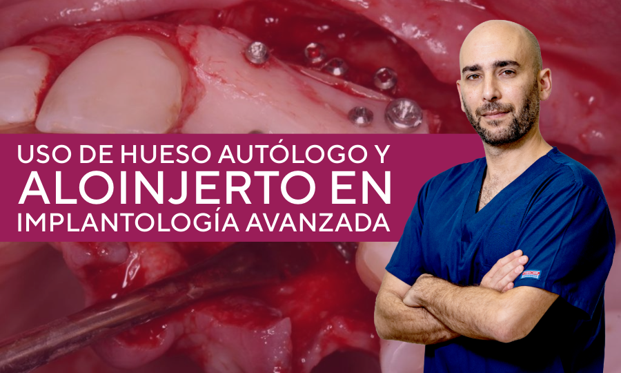 Curso hueso autólogo y aloinjerto