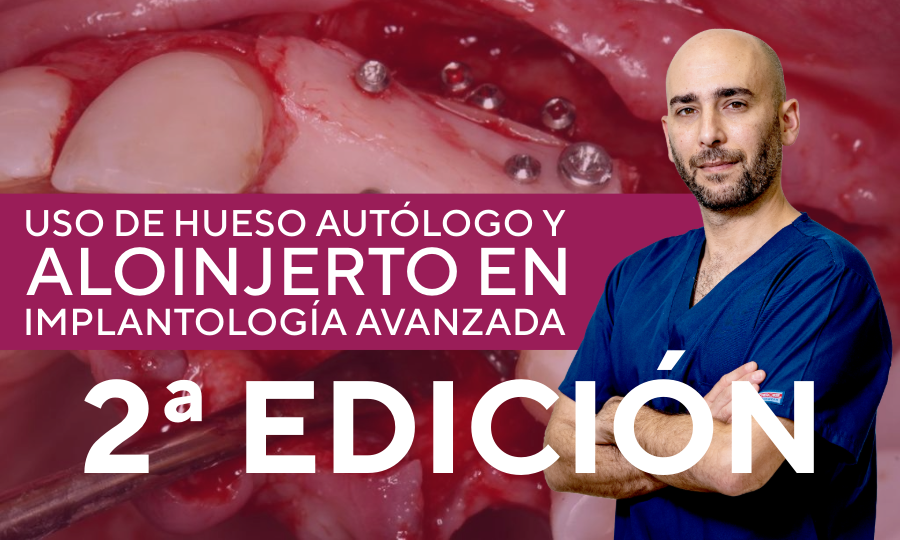 Curso hueso autólogo y aloinjerto