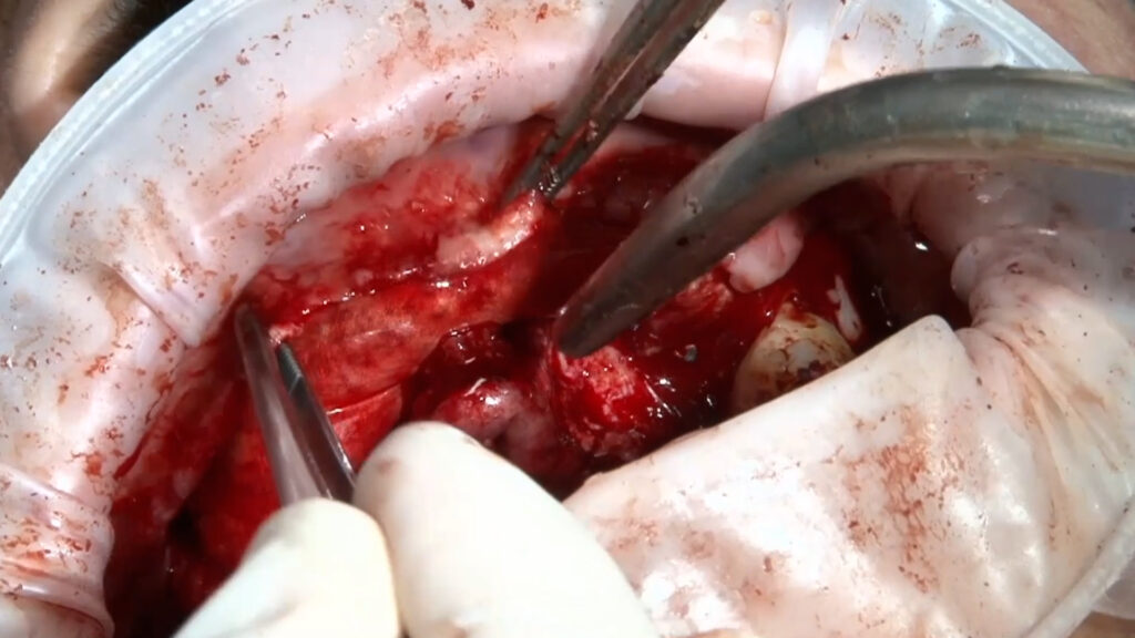 papel del colgajo en el éxito de una ROG