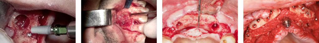 tejido blando en implantes